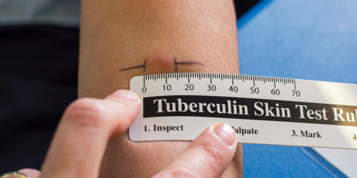 БЦЖ та Манту: у чому різниця?